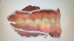 Digital scan of pediatric dentition Digital scan of pediatric dentition