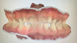 Digital scan of pediatric dentition Digital scan of pediatric dentition