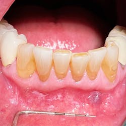 Figure 2: The same area after the white patches were wiped off with gauze. Figure 2: The same area after the white patches were wiped off with gauze.