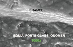 Figure 2: Equia Forte, one of the new conventional glass ionomers in vivo, showing exact adaptation to the enamel walls of a tooth preparation. Glass ionomers have a chemical seal to tooth structure and are recommended as a dentinal replacement. Photo courtesy of TRAC Research, CR Foundation.