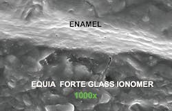 Figure 2: Equia Forte, one of the new conventional glass ionomers in vivo, showing exact adaptation to the enamel walls of a tooth preparation. Glass ionomers have a chemical seal to tooth structure and are recommended as a dentinal replacement. Photo courtesy of TRAC Research, CR Foundation. Figure 2: Equia Forte, one of the new conventional glass ionomers in vivo, showing exact adaptation to the enamel walls of a tooth preparation. Glass ionomers have a chemical seal to tooth structure and are recommended as a dentinal replacement. Photo courtesy of TRAC Research, CR Foundation.