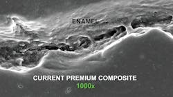 Figure 1: All composite restorations leak at the prep margins as shown in this in vivo electron microscope photo at three years of service Figure 1: All composite restorations leak at the prep margins as shown in this in vivo electron microscope photo at three years of service