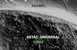 Figures 2 and 3: Conventional glass ionomer actually seals prep margins as noted in these photos now three years in the mouth Figures 2 and 3: Conventional glass ionomer actually seals prep margins as noted in these photos now three years in the mouth