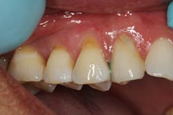 Figure 1: Pre-op view showing Class V cervical abrasions on nos. 4 and 5, and a chipped restoration on the cervical area of tooth no. 6. Figure 1: Pre-op view showing Class V cervical abrasions on nos. 4 and 5, and a chipped restoration on the cervical area of tooth no. 6.