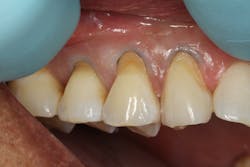 Figure 2: Teeth nos. 4, 5, and 6 had #00 packing cord placed on the facial/buccal margin, the teeth were prepared, and bonding agent was added. Figure 2: Teeth nos. 4, 5, and 6 had #00 packing cord placed on the facial/buccal margin, the teeth were prepared, and bonding agent was added.