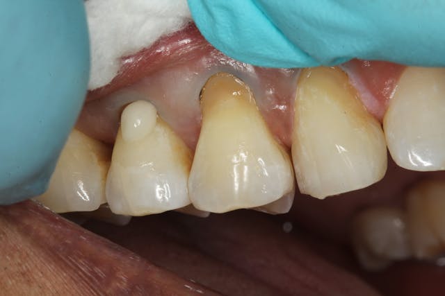 Figure 3: Omnichroma was first added to the buccal of tooth no. 4. Note how much whiter it is than the tooth structure prior to light curing.