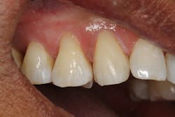 Figure 4: Immediate post-op view of nos. 4, 5, and 6, showing excellent color-match. Figure 4: Immediate post-op view of nos. 4, 5, and 6, showing excellent color-match.