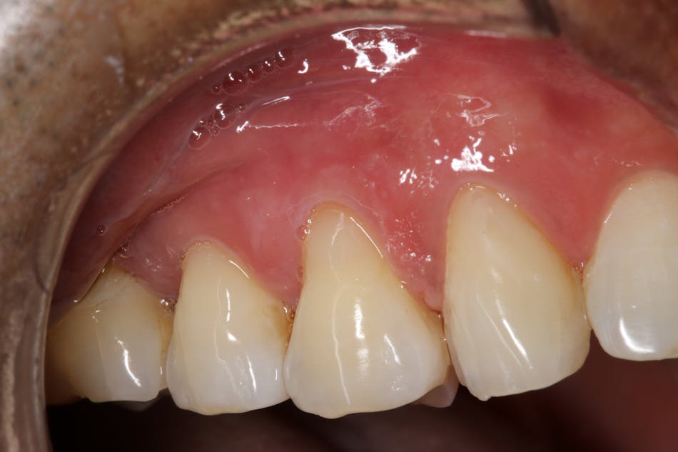 Figure 5: At the one-year post-op check, the restoration has maintained its polish and color-match.