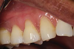 Figure 6: One-and-a-half-year post-op check. Figure 6: One-and-a-half-year post-op check.