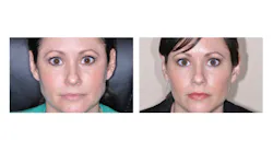 Figure 1: Before (left) and after (right) photo of a patient whose long-standing sleep bruxism and orofacial pain were successfully treated with Botox injections.