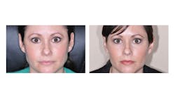 Figure 1: Before (left) and after (right) photo of a patient whose long-standing sleep bruxism and orofacial pain were successfully treated with Botox injections. Figure 1: Before (left) and after (right) photo of a patient whose long-standing sleep bruxism and orofacial pain were successfully treated with Botox injections.