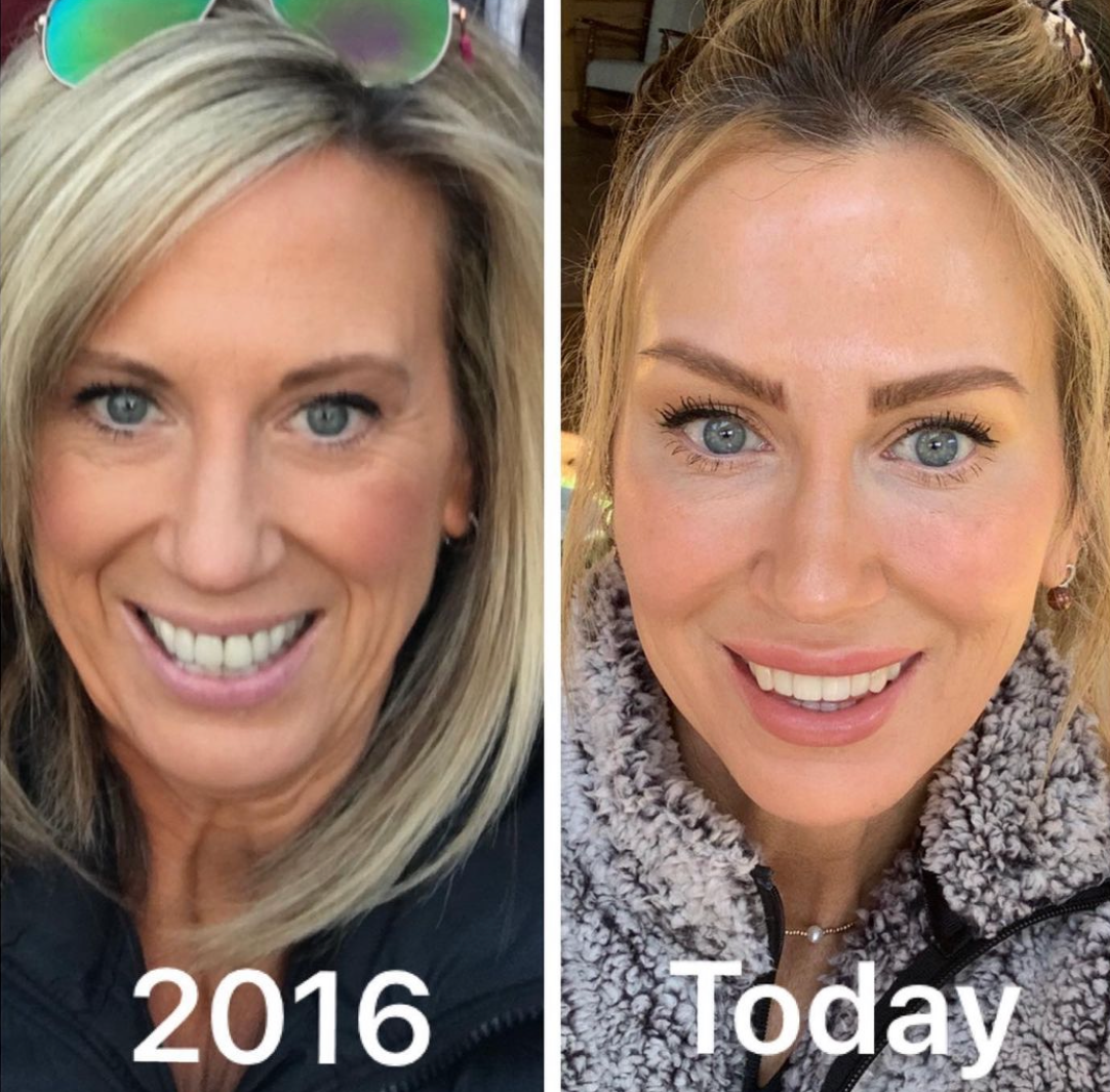 Figure 2: Photos avant et après montrant le Botox, les charges, le traitement des facettes en porcelaine, gracieuseté du Dr Jon Hendrickson @dollyvitaaesthetics.