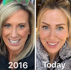 Figure 2: Before and after photos showing Botox, fillers, porcelain veneers treatment courtesy of Dr. Jon Hendrickson @dollyvitaaesthetics.