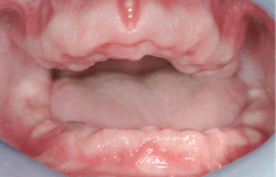 Figure 1: It is unfortunate that dentists and patients allow caries to destroy natural teeth, resulting in about 40 million people in the US being edentulous.