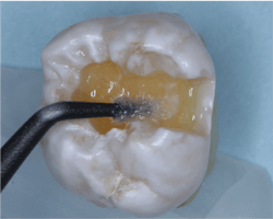 Figure 2: Disinfection and desensitization is well-proven to be produced by two one-minute applications of 5% glutaraldehyde 35% HEMA solutions (MicroPrime or Gluma). Figure 2: Disinfection and desensitization is well-proven to be produced by two one-minute applications of 5% glutaraldehyde 35% HEMA solutions (MicroPrime or Gluma).