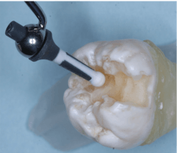 Figure 3: The GI should replace the removed dentin, not cover the margins. Smooth the GI with the instrument of your choice (Ivoclar Vivadent OptraSculpt, American Eagle Dr. Colonna series).