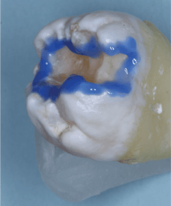 Figure 4: Acid-etch (selective, self-, or total) and wash/dry (Ultradent Ultra-Etch). Acid-etching produces the expected enamel retention. Research has shown significant luting retention on the conventional GI. Figure 4: Acid-etch (selective, self-, or total) and wash/dry (Ultradent Ultra-Etch). Acid-etching produces the expected enamel retention. Research has shown significant luting retention on the conventional GI.