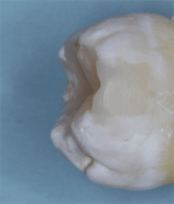 Figure 5: The finished GI/resin restoration after finishing and polishing. Figure 5: The finished GI/resin restoration after finishing and polishing.