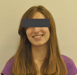 Figure 2: Patient presents with narrow deficient smile and open buccal corridors