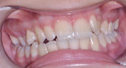 Figure 3: Patient diagnosis: Class I crowded malocclusion caused by maxillary underdevelopment Figure 3: Patient diagnosis: Class I crowded malocclusion caused by maxillary underdevelopment