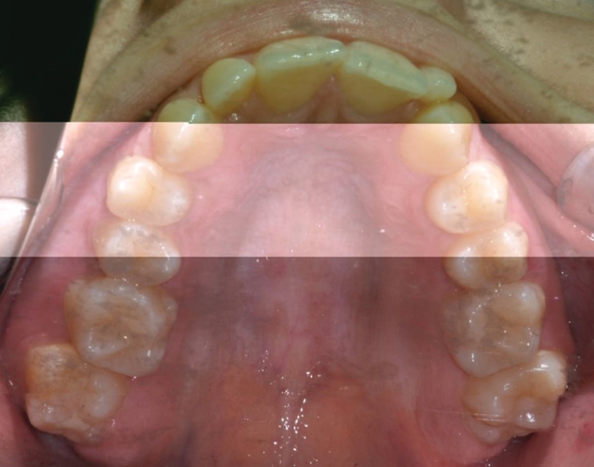 Microosteoperforations, VPro vibration device, and aligner therapy can