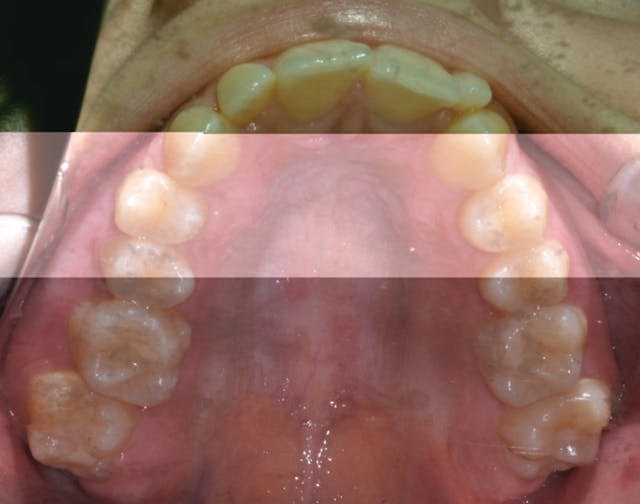 Microosteoperforations, VPro vibration device, and aligner therapy can