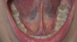 Figure 5: Patient displays a moderate tongue-tie, scoring 5 on the Marchesan Frenum Protocol Figure 5: Patient displays a moderate tongue-tie, scoring 5 on the Marchesan Frenum Protocol