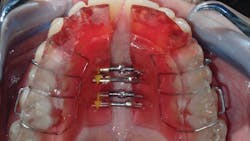 Figure 6: Patient achieves significant maxillary growth in eight months with the use of accelerated orthodontics (VPro+ device)