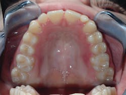 Figure 7: Patient achieves 7 mm of development resulting in a 34 mm TM and changes in palatal vault anatomy Figure 7: Patient achieves 7 mm of development resulting in a 34 mm TM and changes in palatal vault anatomy