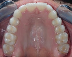 Figure 8: Patient after palatal expansion and clear aligner therapy. Achieves 10 mm of expansion, which equals 37 mm of TM. Figure 8: Patient after palatal expansion and clear aligner therapy. Achieves 10 mm of expansion, which equals 37 mm of TM.