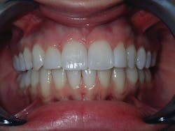 Figure 9: Clear aligners deliver full alignment and proper occlusion
