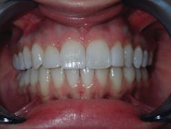 Figure 9: Clear aligners deliver full alignment and proper occlusion Figure 9: Clear aligners deliver full alignment and proper occlusion
