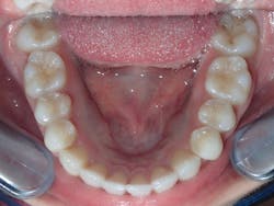 Figure 10: The tongue has an increased amount of oral cavity volume