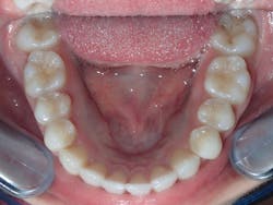 Figure 10: The tongue has an increased amount of oral cavity volume Figure 10: The tongue has an increased amount of oral cavity volume
