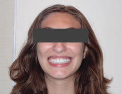 Figure 11: Patient is completely asymptomatic and thriving, and has a beautiful, healthy smile.
