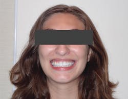 Figure 11: Patient is completely asymptomatic and thriving, and has a beautiful, healthy smile. Figure 11: Patient is completely asymptomatic and thriving, and has a beautiful, healthy smile.