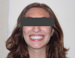 Figure 11: Patient is completely asymptomatic and thriving, and has a beautiful, healthy smile. Figure 11: Patient is completely asymptomatic and thriving, and has a beautiful, healthy smile.