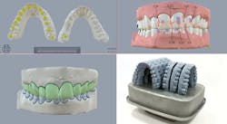 Figure 8: Low-cost or free software, such as ArchForm, allows dentists to design aligner cases for $50. Figure 8: Low-cost or free software, such as ArchForm, allows dentists to design aligner cases for $50.