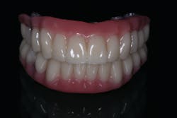 Figure 10: 3D printed hybrid temporaries made on the EnvisionTEC EnvisionOne printer. Figure 10: 3D printed hybrid temporaries made on the EnvisionTEC EnvisionOne printer.