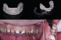 Figure 12: This 3D printed diagnostic wax-up can be used to make provisionals, as well as serve as a gingival reduction guide.