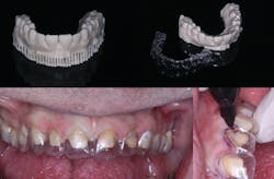 Figure 12: This 3D printed diagnostic wax-up can be used to make provisionals, as well as serve as a gingival reduction guide. Figure 12: This 3D printed diagnostic wax-up can be used to make provisionals, as well as serve as a gingival reduction guide.