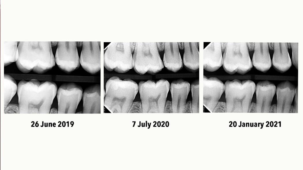 Figure 6: Three dated bitewing radiographs, chronologically over 19 months