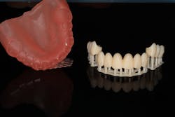 Two-piece denture: The teeth are bonded into the soft tissue resin using uncured resin. They are then cured together and polished prior to delivery.