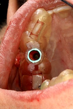 Surgical guide printed in surgical guide resin from SprintRay with guide designed in Blue Sky Plan. Surgical guide printed in surgical guide resin from SprintRay with guide designed in Blue Sky Plan.