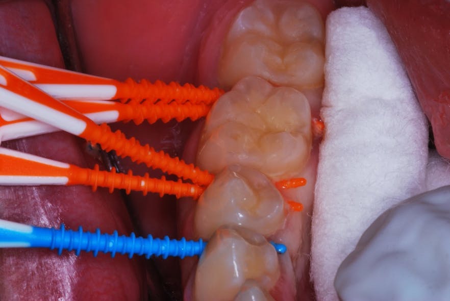 Figure 3: Dental picks inserted. Sometimes two thinner picks can be used to maximize the amount of fluid.