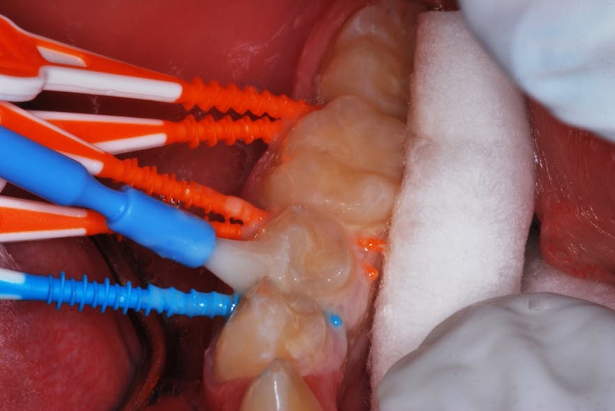 Figure 5: Fluoride varnish covers and protects from salivary dilution and augments the remineralization potential of the procedure.