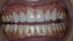 Final restorations Final restorations