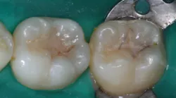 Figure 1: Failed sealants are a common occurrence. Failure can be avoided as described in this article.