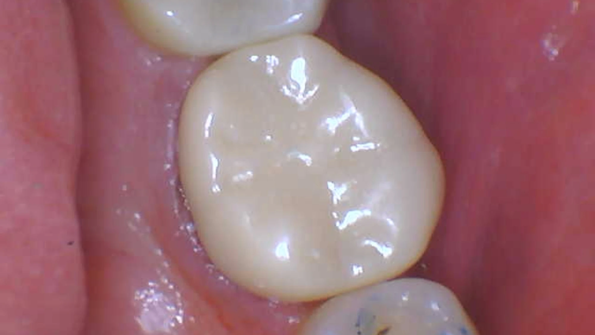 Clear Margins For Single visit Indirect Restorative Dentistry Dental Clear Margins For Single visit Indirect Restorative Dentistry Dental