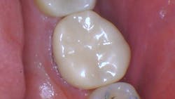 Final zirconia crown cemented Final zirconia crown cemented